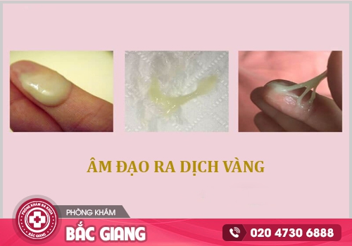 Hình ảnh huyết trắng bình thường và huyết trắng bệnh lý. huyết trắng màu vàng