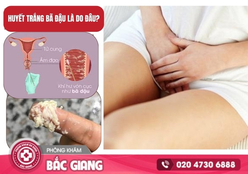 Huyết trắng bã đậu là dấu hiệu của các bệnh lý phụ khoa ở nữ giới, huyết trắng bã đậu