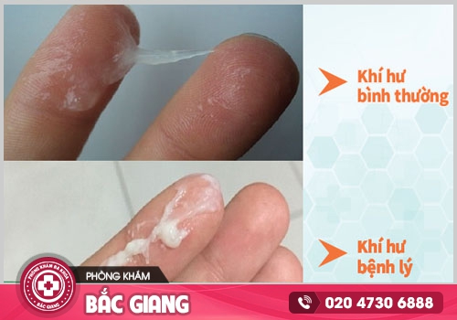 Khí hư bất thường là do đâu? Cách nhận biết qua màu sắc