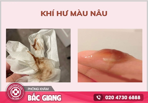 Tình trạng ngứa vùng kín ra khí hư màu nâu do nhiều nguyên nhân khác nhau. ngứa vùng kín ra khí hư màu nâu