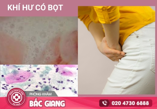 Khí hư có bọt là dấu hiệu cành báo bệnh lý phụ khoa. khí hư có bọt