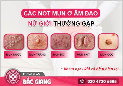 Mụn bộ phận sinh dục nữ là dấu hiệu của nhiều bệnh lý phụ khoa nguy hiểm. mụn bộ phận sinh dục nữ